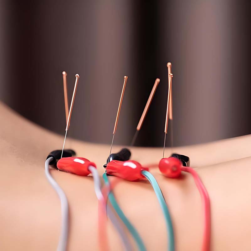 Electroacupuncture